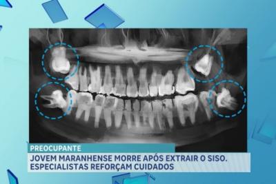 Após morte de jovem, cirurgião-dentista reforça cuidados ao extrair o dente siso