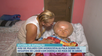 Mãe de mulher com hidrocefalia fala sobre os desafios de lidar com a doença há mais de 30 anos 