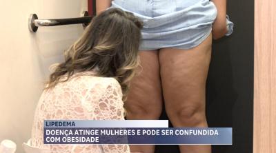 Lipedema: doença crônica que pode ser confundida com a obesidade