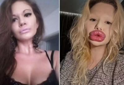Mulher com ‘maiores lábios do mundo’ diz que dentistas recusam atendimento