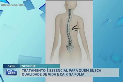 Vem Comigo: Especialista fala sobre escoliose e seus sintomas