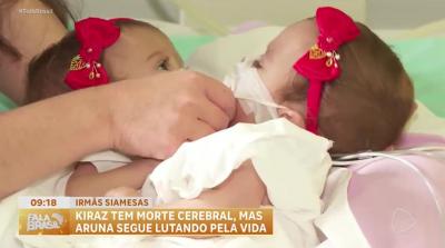 Morre uma das gêmeas siamesas separadas em cirurgia de 20 horas