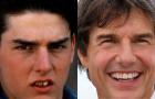 Tom Cruise, Glória Pires e Cristiano Ronaldo investiram pesado para renovar os dentes